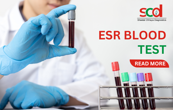 /storage/photos/1/Blog/ESR BLOOD TEST.png